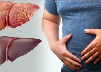 লিভার ডিজিজ: নিরব মহামারিতে রূপ নিচ্ছে