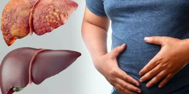 লিভার ডিজিজ: নিরব মহামারিতে রূপ নিচ্ছে