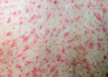 দ্রুত ছড়াচ্ছে সংক্রামক রোগ হাম, ঝুঁকিতে রাজশাহীর শিশুরা