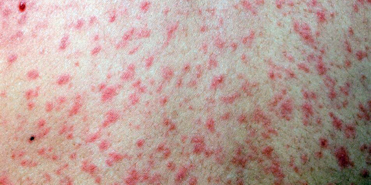 দ্রুত ছড়াচ্ছে সংক্রামক রোগ হাম, ঝুঁকিতে রাজশাহীর শিশুরা