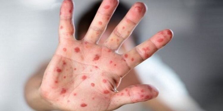 হাম কখন বিপজ্জনক, প্রতিরোধে অভিভাবকরা যা করবেন