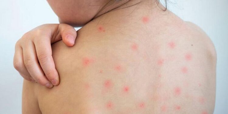 হামের উপসর্গ নিয়ে আরও ৪ জনের মৃত্যু