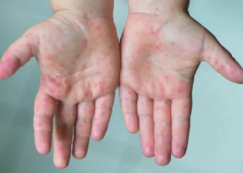 হামে মৃত্যু দেড়শ ছাড়াল