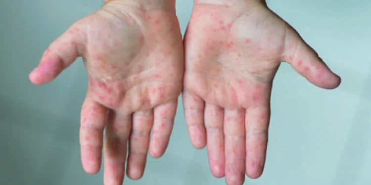 হামে মৃত্যু দেড়শ ছাড়াল