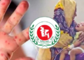 হামের উপসর্গ নিয়ে ২৪ ঘণ্টায় আরও ৪ শিশুর মৃত্যু