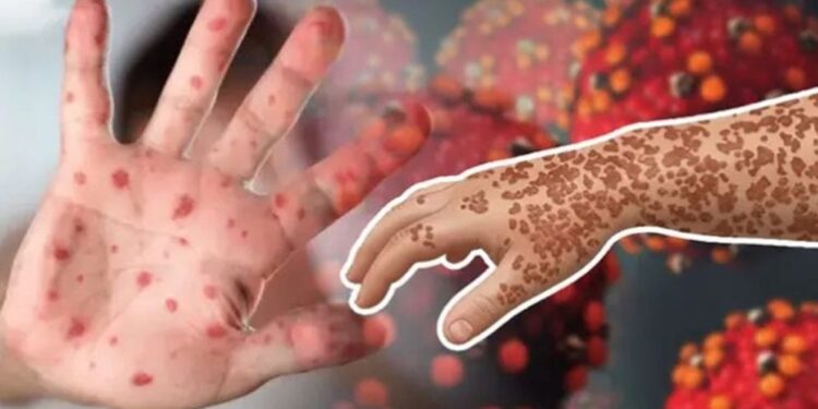 হাম ও উপসর্গে মৃত্যু ছাড়ালো ৩০০